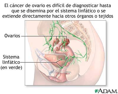Cáncer de ovario