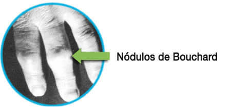 DOLORES ARTROSICOS MANO