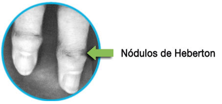 DOLORES ARTROSICOS MANO