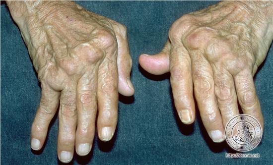 DOLORES ARTROSICOS MANO