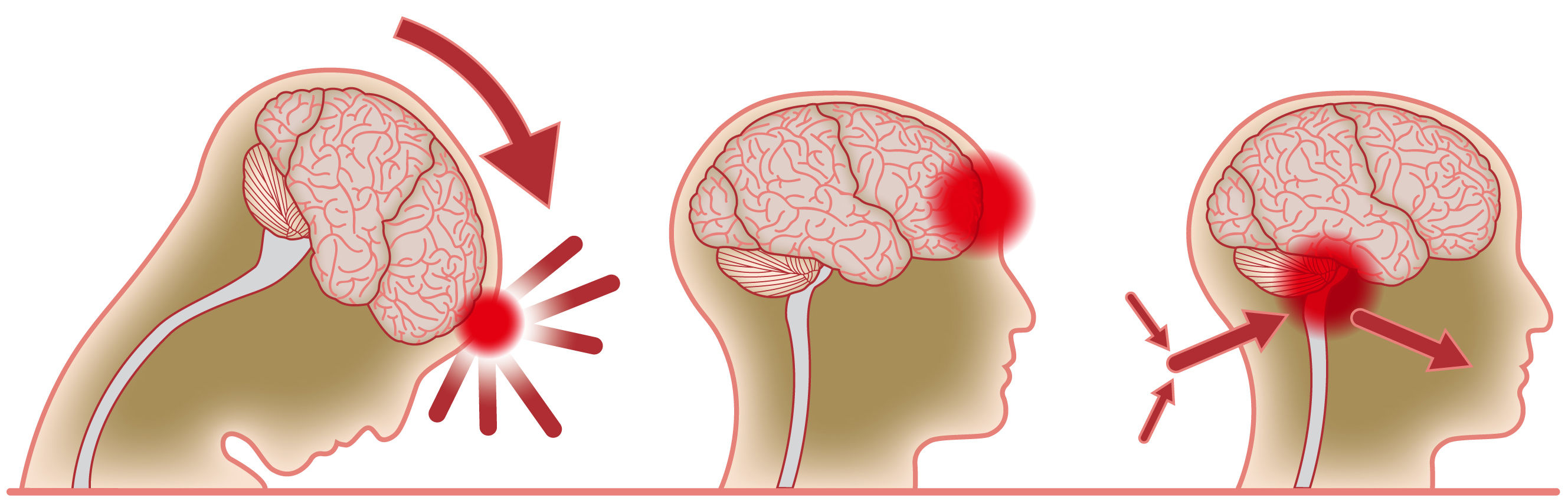 Daño Cerebral
