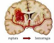 Daño Cerebral