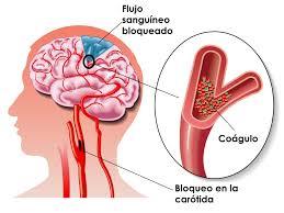 Daño Cerebral