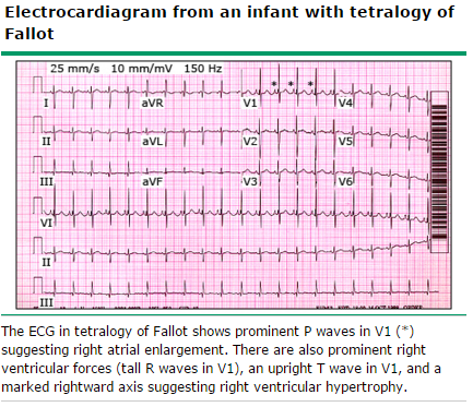 TETRALOGIA DE FALLOT