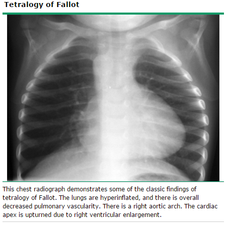 TETRALOGIA DE FALLOT