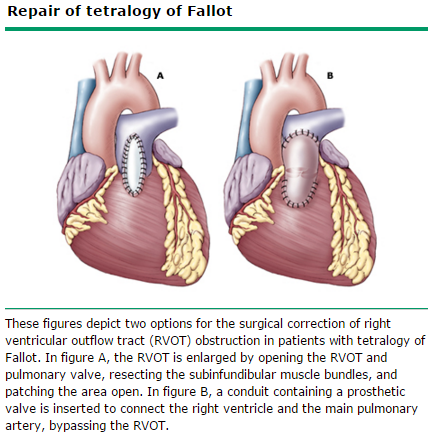 TETRALOGIA DE FALLOT