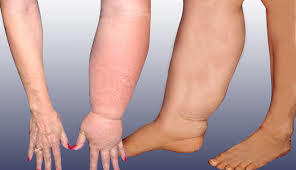 Fisioterapia cardiovascular