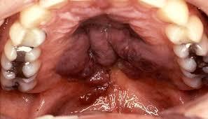 sarcoma de kaposi