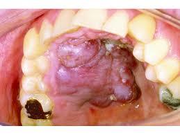 sarcoma de kaposi