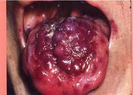 sarcoma de kaposi