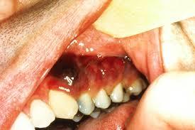 sarcoma de kaposi