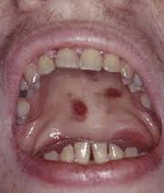 sarcoma de kaposi
