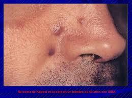 sarcoma de kaposi