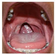 sarcoma de kaposi