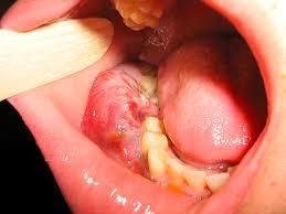 sarcoma de kaposi
