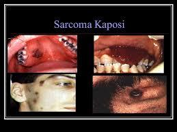 sarcoma de kaposi