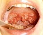 sarcoma de kaposi