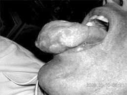 sarcoma de kaposi