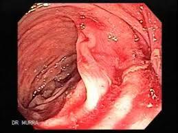 sarcoma de kaposi