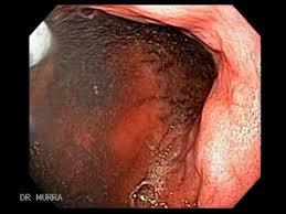 sarcoma de kaposi