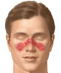 Lupus eritematoso sistemico