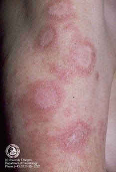 Lupus eritematoso sistemico
