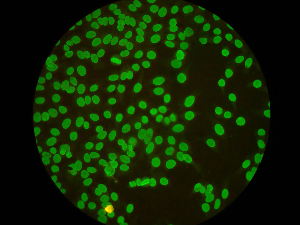Lupus eritematoso sistemico