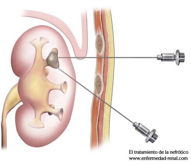 Lupus eritematoso sistemico