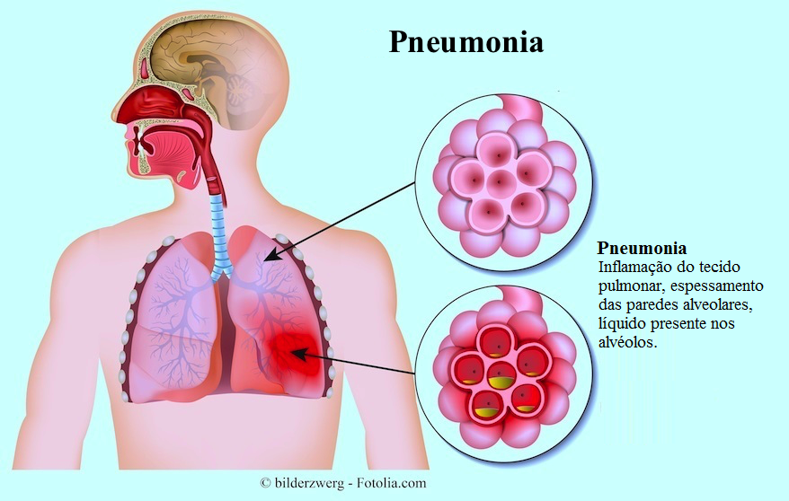 Pneumonia adquirida na comunidade: economia de cuidados médicos, em relação à gravidade clínica