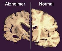 CAPACIDADE FUNCIONAL DE IDOSOS COM DOENÇA DE ALZHEIMER E PARKINSON