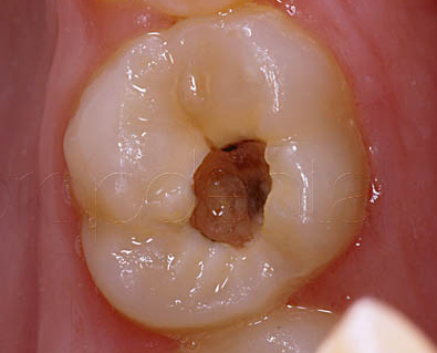 PATOLOGIA PULPAR Y PERIAPICAL EN DIENTES DECIDUOS
