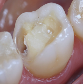 PATOLOGIA PULPAR Y PERIAPICAL EN DIENTES DECIDUOS
