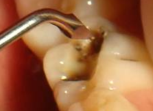 PATOLOGIA PULPAR Y PERIAPICAL EN DIENTES DECIDUOS