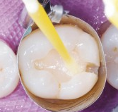 PATOLOGIA PULPAR Y PERIAPICAL EN DIENTES DECIDUOS