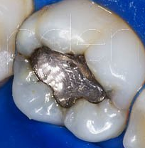 PATOLOGIA PULPAR Y PERIAPICAL EN DIENTES DECIDUOS