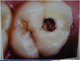 PATOLOGIA PULPAR Y PERIAPICAL EN DIENTES DECIDUOS