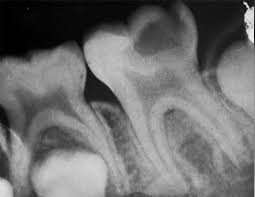 PATOLOGIA PULPAR Y PERIAPICAL EN DIENTES DECIDUOS