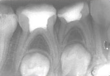 PATOLOGIA PULPAR Y PERIAPICAL EN DIENTES DECIDUOS