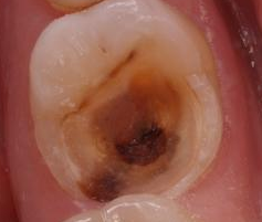 PATOLOGIA PULPAR Y PERIAPICAL EN DIENTES DECIDUOS
