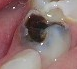 PATOLOGIA PULPAR Y PERIAPICAL EN DIENTES DECIDUOS