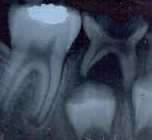 PATOLOGIA PULPAR Y PERIAPICAL EN DIENTES DECIDUOS