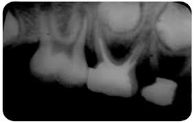 PATOLOGIA PULPAR Y PERIAPICAL EN DIENTES DECIDUOS