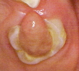 PATOLOGIA PULPAR Y PERIAPICAL EN DIENTES DECIDUOS