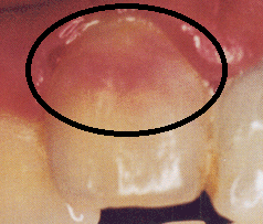 PATOLOGIA PULPAR Y PERIAPICAL EN DIENTES DECIDUOS