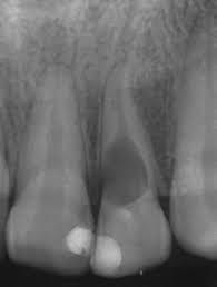 PATOLOGIA PULPAR Y PERIAPICAL EN DIENTES DECIDUOS