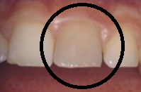 PATOLOGIA PULPAR Y PERIAPICAL EN DIENTES DECIDUOS