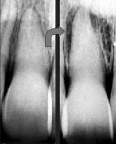 PATOLOGIA PULPAR Y PERIAPICAL EN DIENTES DECIDUOS
