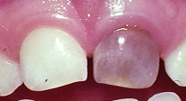 PATOLOGIA PULPAR Y PERIAPICAL EN DIENTES DECIDUOS