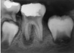 PATOLOGIA PULPAR Y PERIAPICAL EN DIENTES DECIDUOS