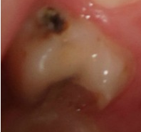 PATOLOGIA PULPAR Y PERIAPICAL EN DIENTES DECIDUOS